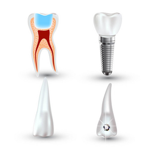 向量集的 3d 白色背景上分离的现实干净或脏牙。牙齿健康概念。口腔护理，牙修复