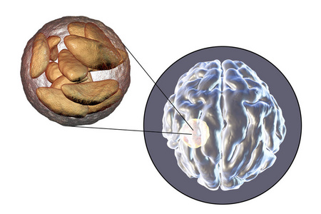 脑脓肿引起的寄生原虫的弓形虫图片