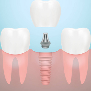 人类的牙齿与牙科植入物分离背景上。矢量图