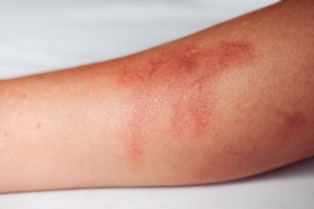 为烧伤伤口贴创口贴图片