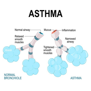 哮喘。泡和细支气管