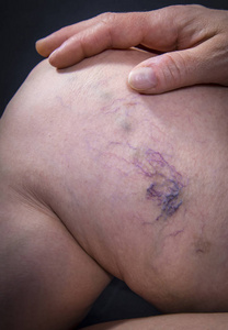 人体腿部静脉曲张照片