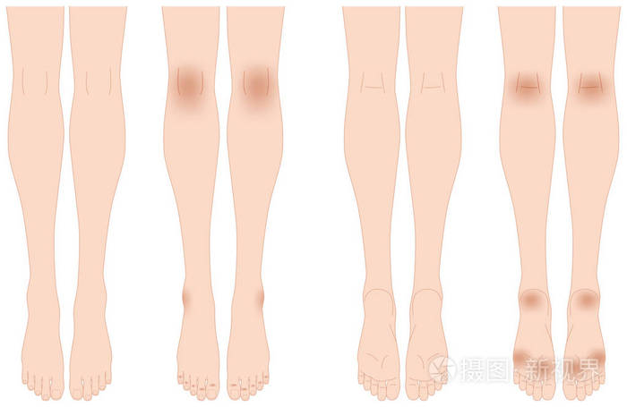 legs.darkening 的皮肤插画-正版商用图片01z6nm-摄图新视界
