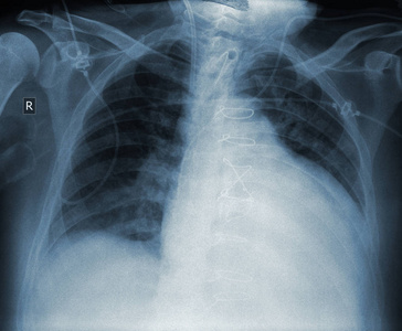 心脏病手术后患者的 x 光照片