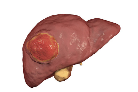 肝细胞癌图