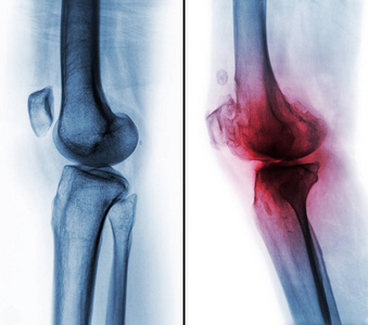 正常人膝关节 左图 和膝关节骨性关节炎 右图 之间的比较。横向视图
