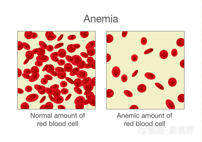正常的大量红细胞和贫血的区别
