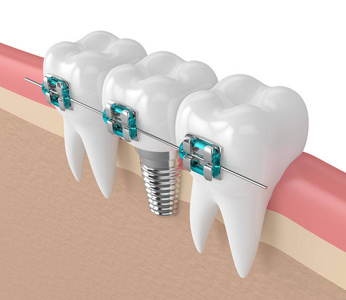 3d. 牙种植体和支架的牙齿呈现