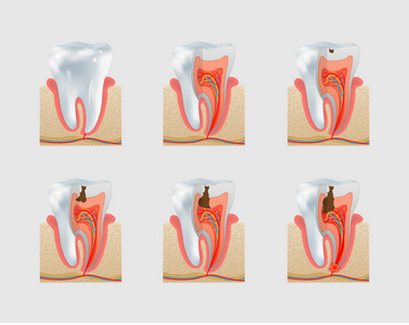 矢量健康牙与牙本质龋图标集