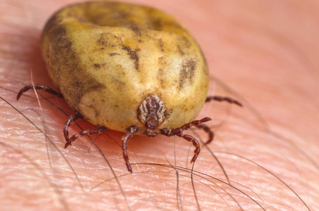 满腔热血坐在人体皮肤上的蜱虫照片