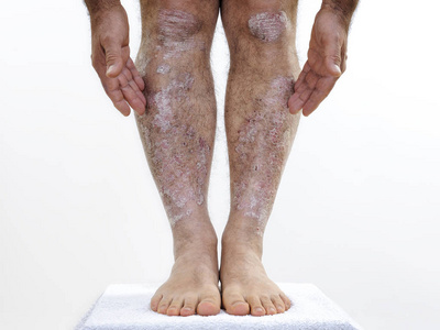 成年白种人患牛皮癣在腿照片