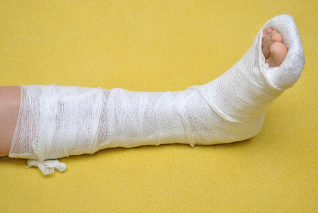 图片断了的胳膊在绷带腿断了的女孩拄着拐杖跳断了的旧绳子断了的胳膊