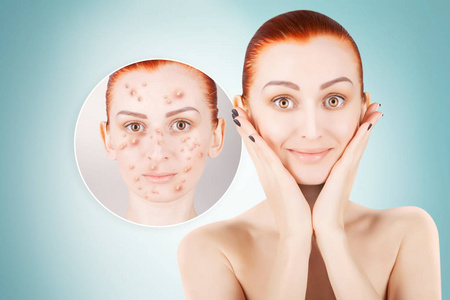 女性痤疮图片-女性痤疮素材-女性痤疮插画-摄图新视界