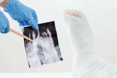 医生检查病人的腿摔断的躺在沙发上打着石膏的 x 射线图像