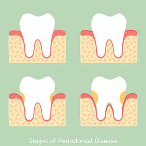 牙周病牙周炎牙龈炎牙龈疾病, 牙科问题的步骤图片