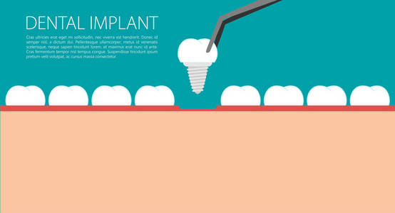 牙科种植体平坦背景图片