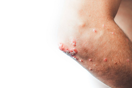 牛皮癣问题图片