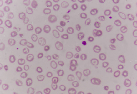 巨型血小板血红细胞背景