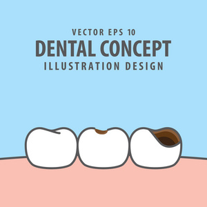 在蓝色背景上的龋齿和空洞牙插图向量