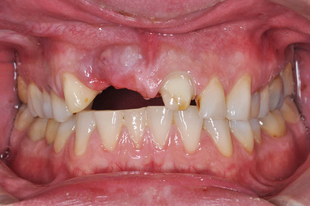 牙科门诊病人口无牙的闭合