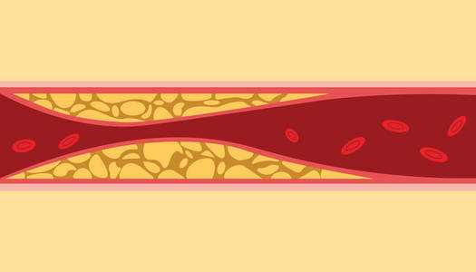 非健康胆固醇人血静脉细胞流与脂肪在平面式插图旁边