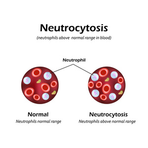 中性粒细胞均高于血液中的正常范围。Neutrocytosis。矢量图