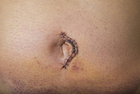 脐疝带脐疝修复手术照片