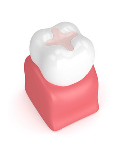 3d 牙嵌体充填的牙齿呈现