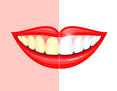 漂白牙齿治疗。美白牙齿前后。在粉红色和白色背景上隔离的矢量插图。牙科护理概念