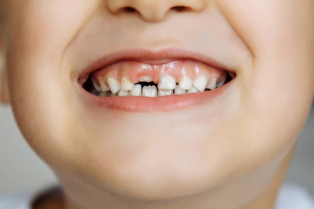门牙男孩与缺牙的肖像男孩刷牙小男孩显示乳牙牙关闭等待新的牙齿无牙