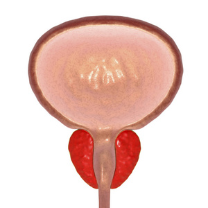 插图前列腺癌, 插图阿托品球和棒模型前列腺, 膀胱的白色图标前列腺癌