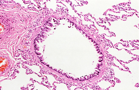 支气管扩张症图片