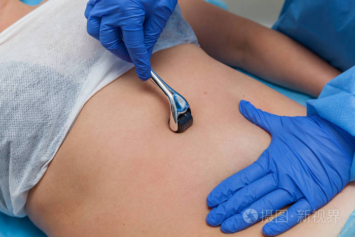 carboxytherapy 在身体