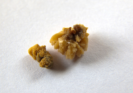 扁桃体结石图片