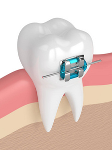3d 在牙龈上的牙括号的渲染