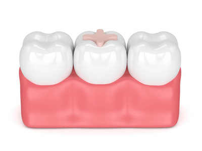 3d 牙齿嵌体充填牙的呈现