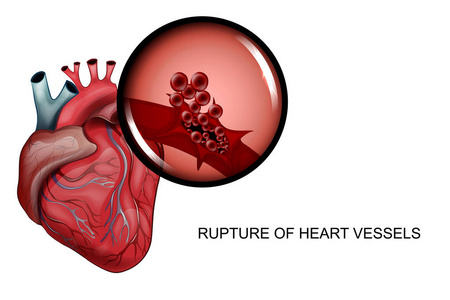 心脏血管破裂