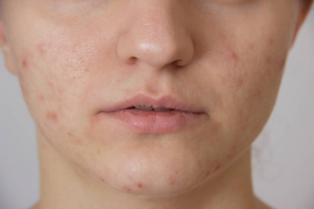 脸上长痤疮图片