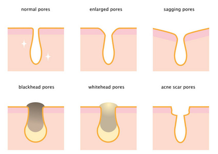 皮肤毛孔集 正常, 下垂, 扩大, 黑头, 白头和痤疮疤痕