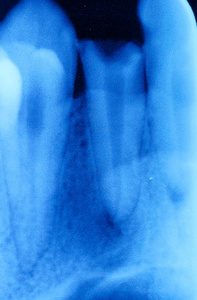 牙齿X光片