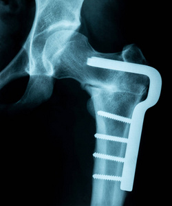 x 射线图像的一个破碎的骨盆髋关节与金属针持有
