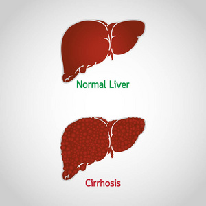 肝硬化矢量徽标图标图示