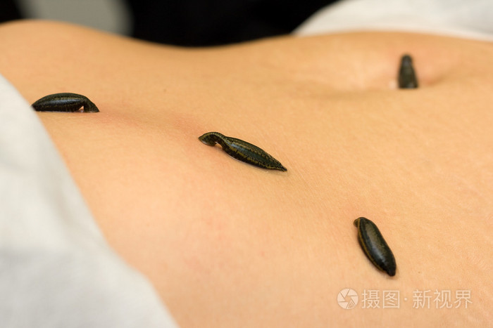 吸血水蛭在胃里