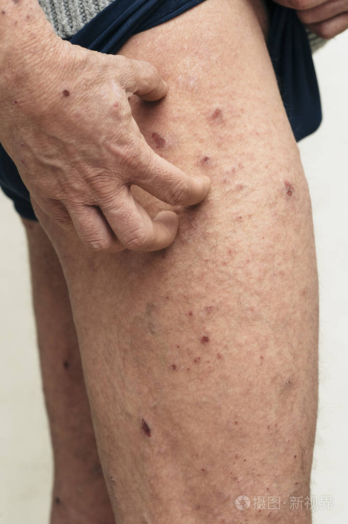 有皮肤瘙痒和干燥问题的人