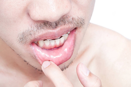 嘴唇的男人问题卫生保健，单纯疱疹的特写