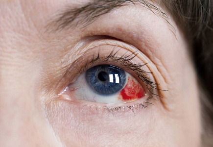 上消化道出血图片