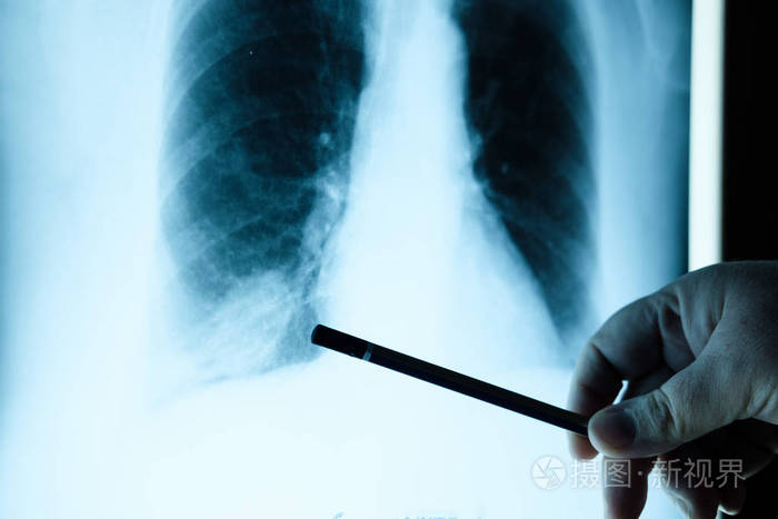医生检查胸部x 光片 医生检查肺部造影照片 正版商用图片03tkxc 摄图新视界