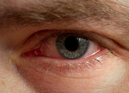 年轻女子出现背部发痒,过敏,皮疹,荨麻疹症状激怒红血丝眼结膜炎的