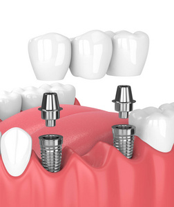 3d. 下颌和牙桥植入物的渲染