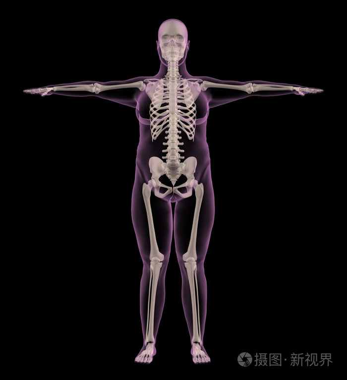 一名体重超重的女性医疗骨架